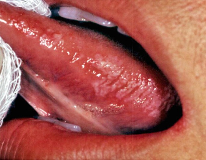 Oral and Maxillofacial Viral Infections | SpringerLink