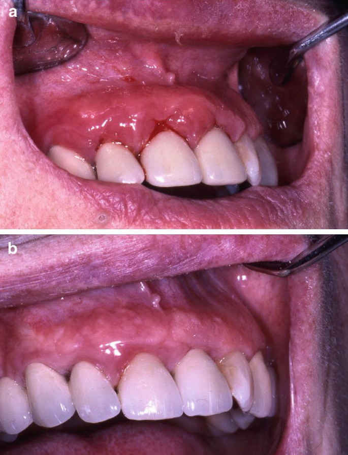 Contact Allergy to Dental Materials and Implants | SpringerLink