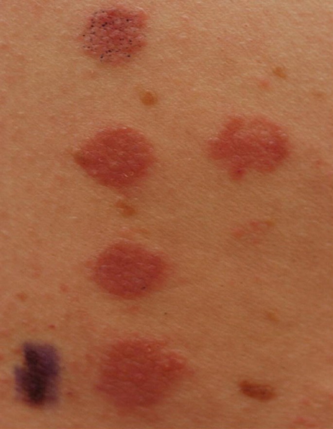 Textile Dermatitis: All About Latex Hypersensitivity & Polyester Allergy