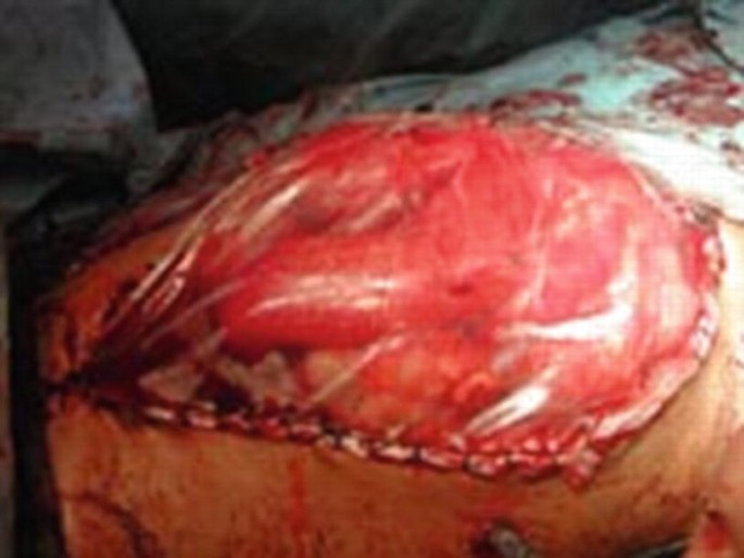 Protuberant abdomen at time of discharge after skinonly closure of