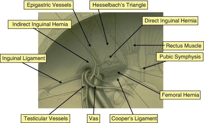Open Posterior Approaches for Femoral Hernia Repair