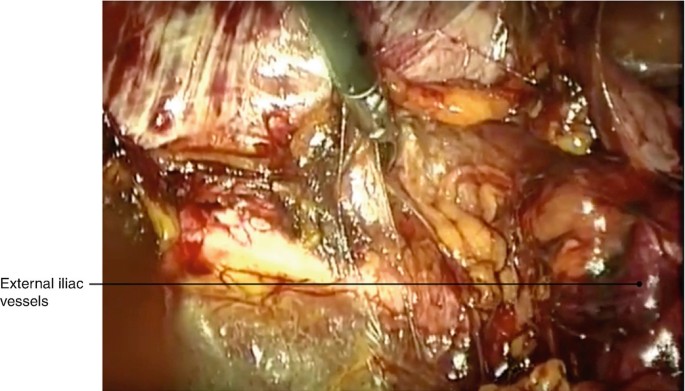 Laparoscopic repair of femoral hernia - Yang - Annals of