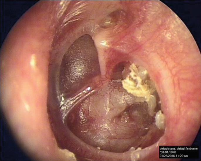 Adhesive Otitis Media | SpringerLink