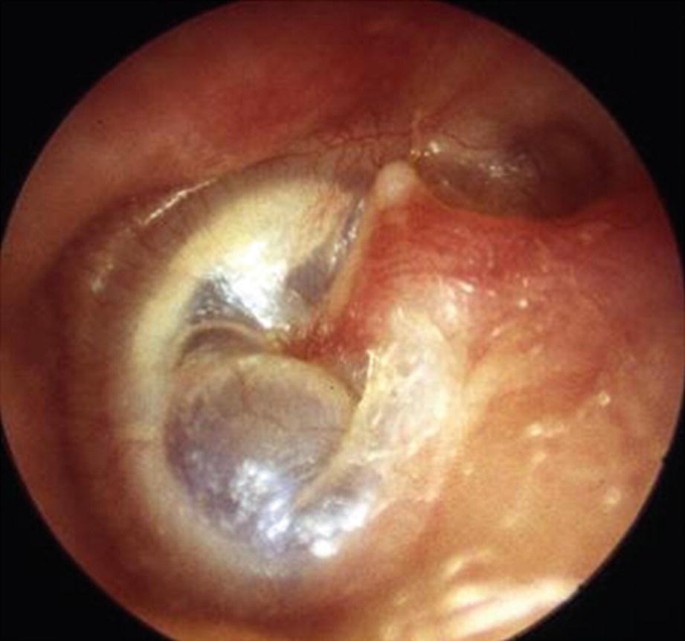 Adhesive Otitis Media | SpringerLink