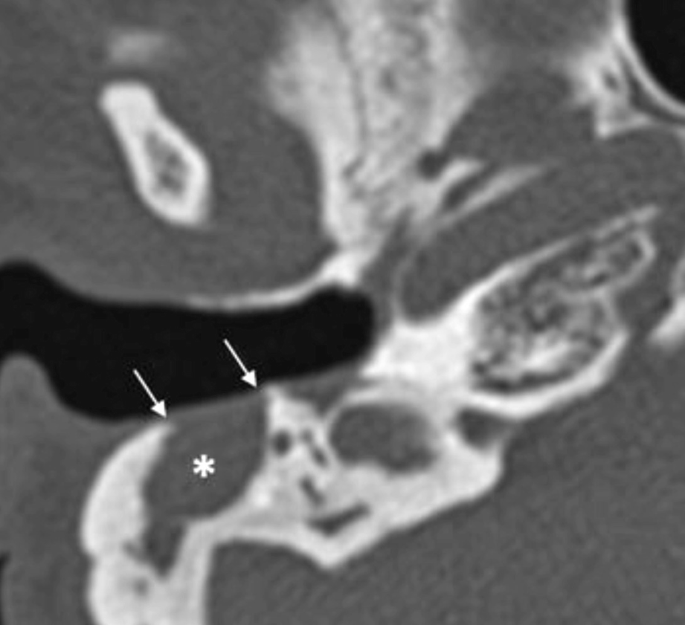 Cholesteatoma Springerlink