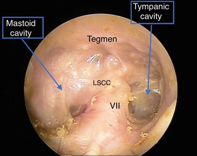 Middle Ear & Mastoid – Oto Surgery Atlas