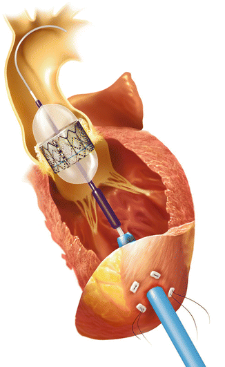 Aortic Valve Replacement | SpringerLink