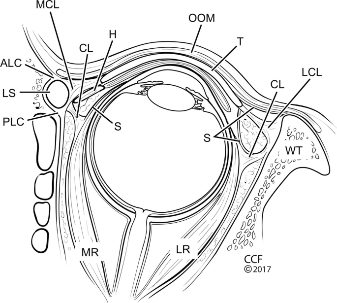 Topographic sketch. Coronal view of bilateral DRT (orange). Patient