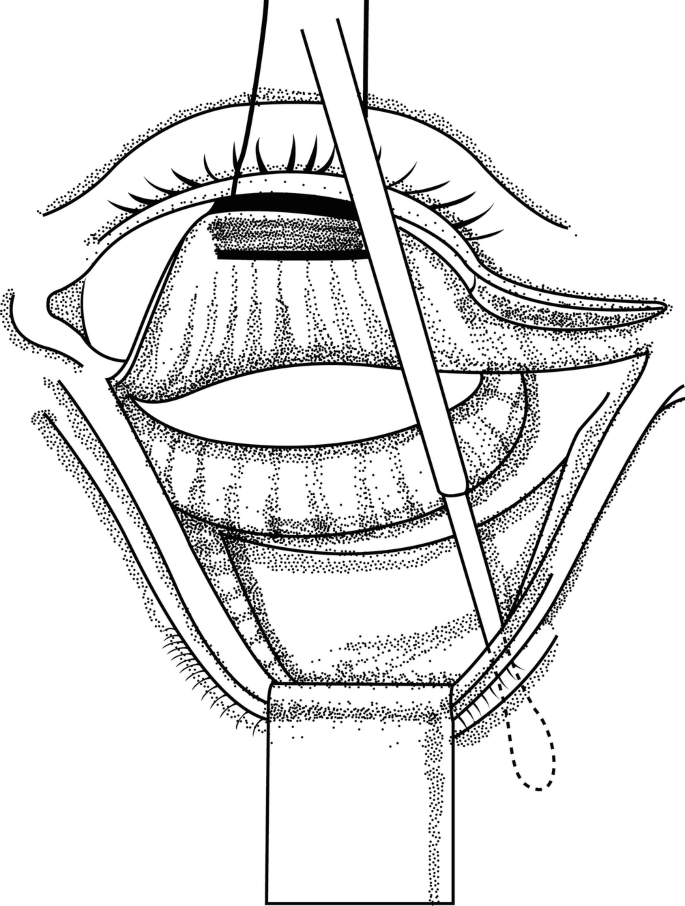 army navy retractor drawing