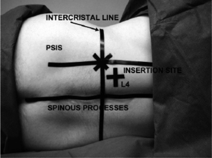 Psoas Zeichen und Obturatorzeichen