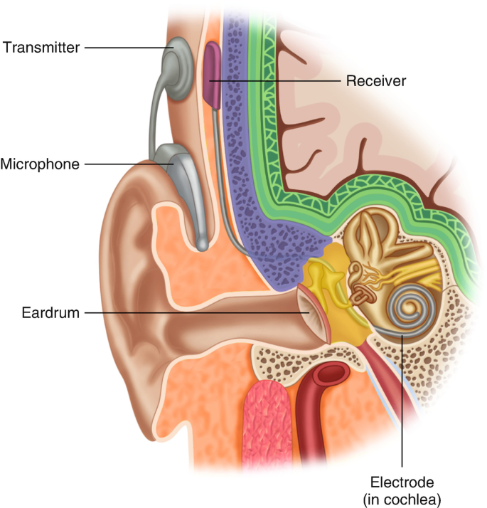 Cochlear Implant Infections | SpringerLink