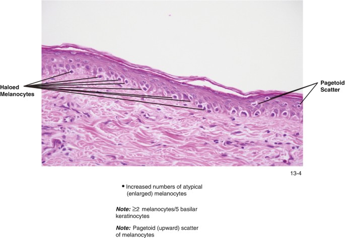 Melanocyte Pathology | SpringerLink