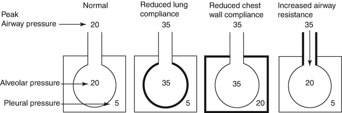Respiratory Complications and Management After Adult Cardiac Surgery |  SpringerLink