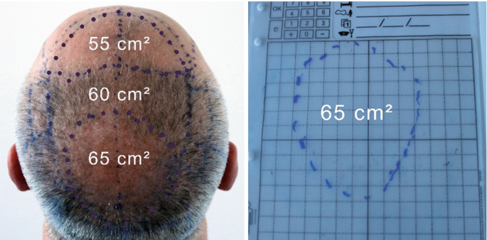 The Technique of Minimally Invasive Hair Transplantation | SpringerLink The Technique of Minimally Invasive Hair Transplantation | SpringerLink