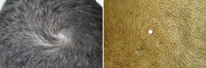 The Technique Of Minimally Invasive Hair Transplantation Springerlink