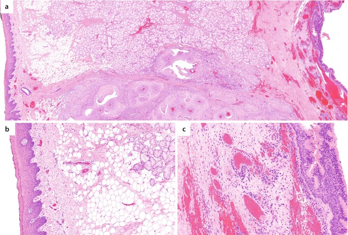 JCDR - Floret giant cells, Ropey collagen, Soft tissue neoplasm