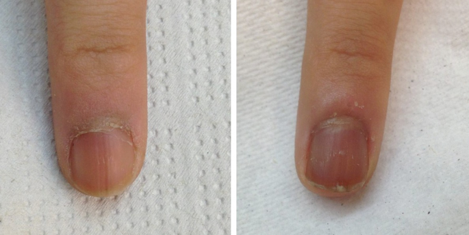 Nail Disorders in Children. - Abstract - Europe PMC