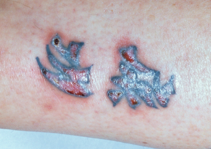 bookofjoe BehindTheMedspeak TattooInduced Skin Burn During MR Imaging