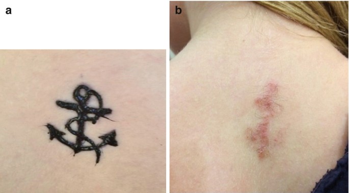 Immune Responses to Tattoos