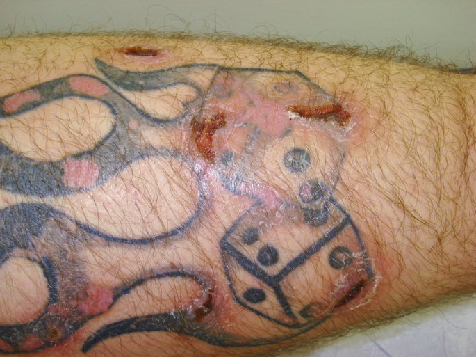 Complications of Tattooing and Scarring | SpringerLink