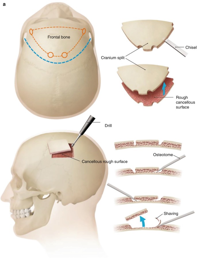 Bone Grafts and Specific Implants in Craniofacial Fracture Treatment |  SpringerLink