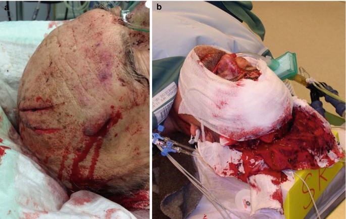 The Patient with Severe Trauma | SpringerLink