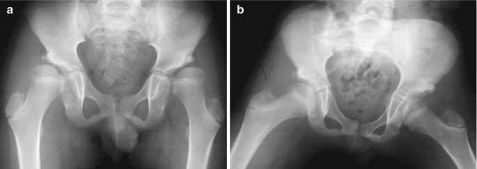 Single Anterior Incision Steel Triple Pelvic Osteotomy | SpringerLink