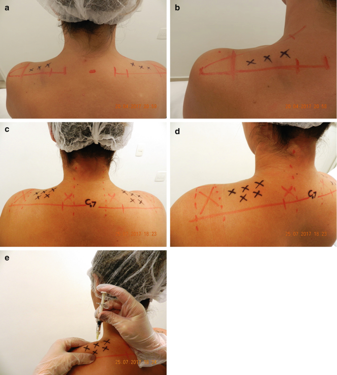 INSIGHTS> LEAN AND FEMININE SHOULDER LINES ACHIEVED WITH BOTULINUM TOXIN