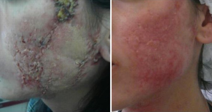 Acne Scars: Bleomycin Plus Triamcinolone Injection (MMP® Technique 