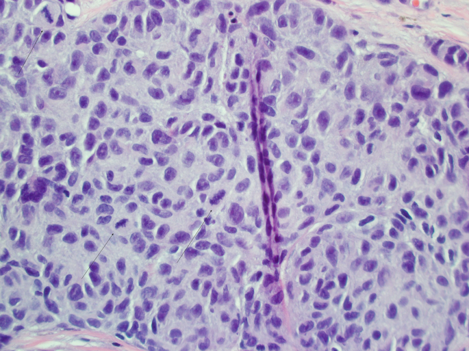 The Pathology of Melanoma | Springer Nature Link