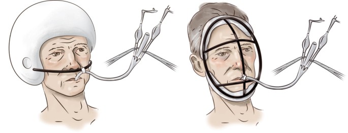blakemore tube football helmet Balloon Tamponade for Variceal Hemorrhage
