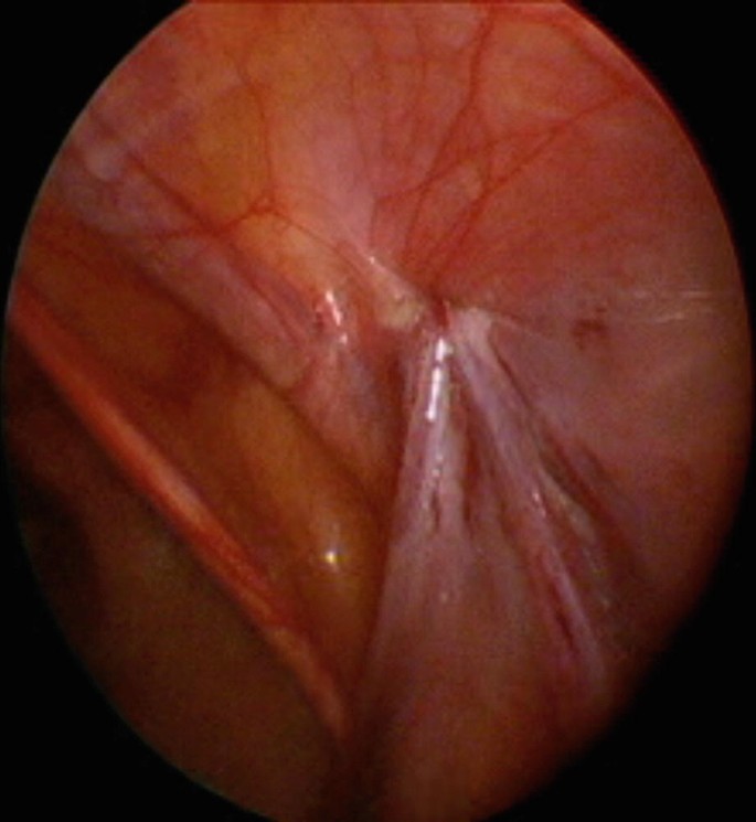 Incarcerated Femoral Hernia and the Ovary Found Within It - SAGES