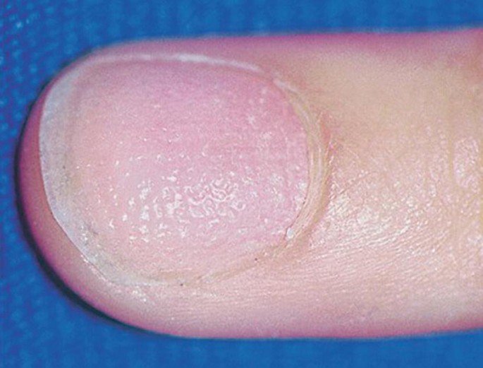 Clinical Pearl: Benzethonium Chloride for Habit-Tic Nail Deformity | MDedge  Dermatology