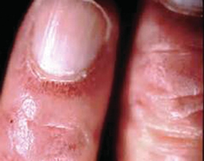 Nail Disorders | SpringerLink