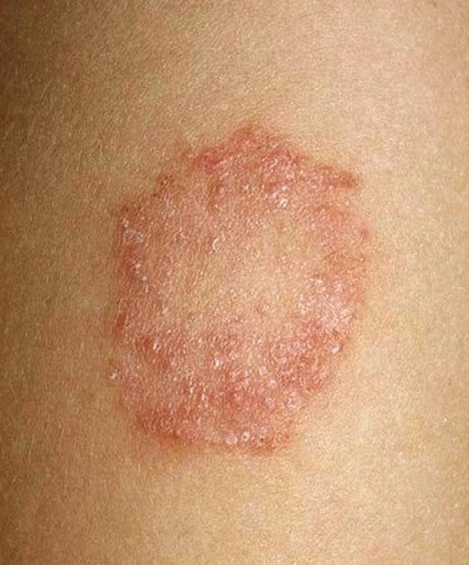 The Best Over The Counter Ringworm Treatment