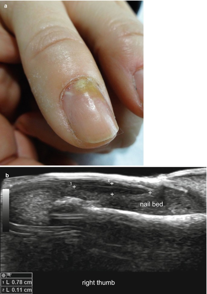 Nonadherence of the Nail Plate | Musculoskeletal Key