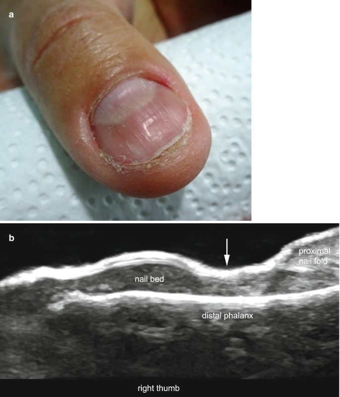 Congenital clasped thumb - Wikipedia