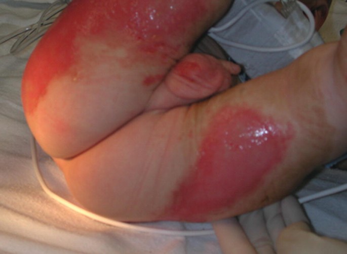 abuse cigarette burns on skin Abusive Burns