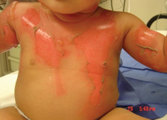 abuse cigarette burns on skin Abusive Burns