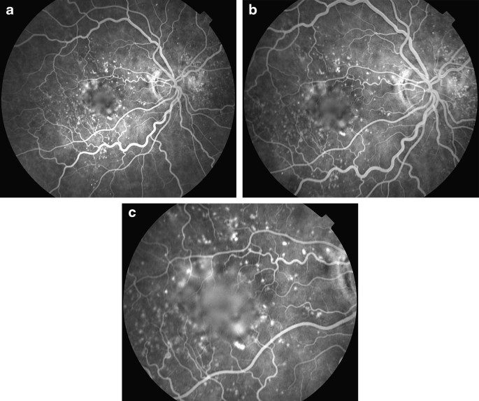 diabetic macular edema fluorescein angiography