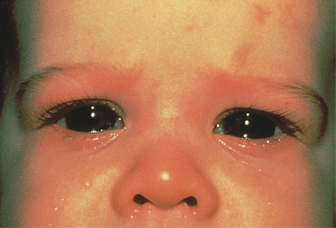 Congenital glaucoma as a presenting feature of Rubinstein-Taybi