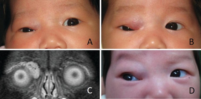 Facial dysmorphism, skeletal anomalies, congenital glucoma