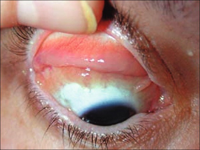 Cureus, Ocular Complications in Patients on Highly Active Antiretroviral  Therapy: A Case Report