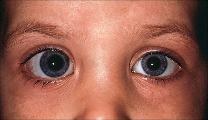Facial dysmorphism, skeletal anomalies, congenital glucoma
