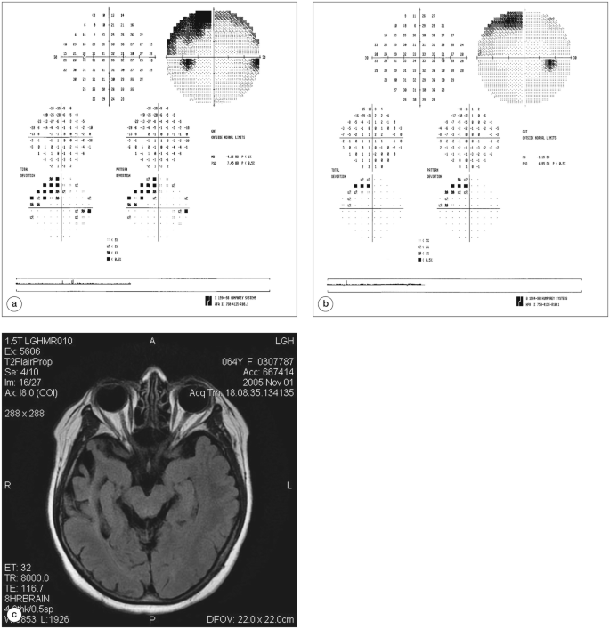 Frontiers | Pediatric autoimmune retinopathy and optic neuropathy: a case  report and a review of the literature