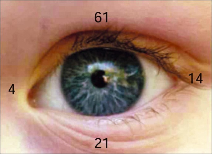 Vascular Anomalies of the Eyelid and Orbit | SpringerLink