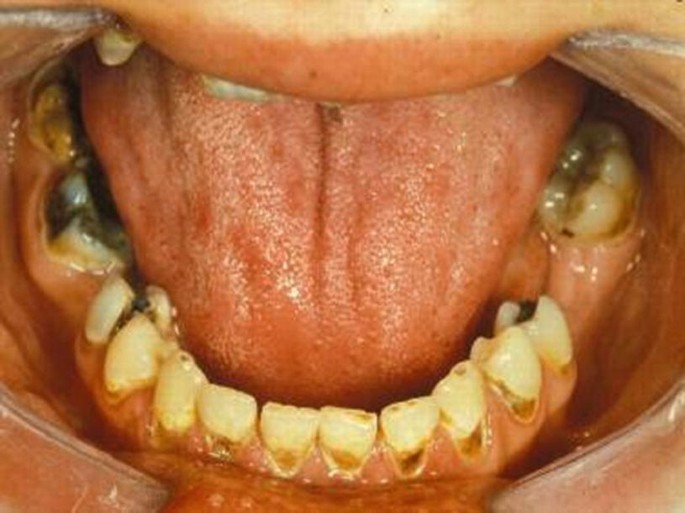 Xerostomia and Dental Problems in the Head and Neck Radiation Patient |  SpringerLink