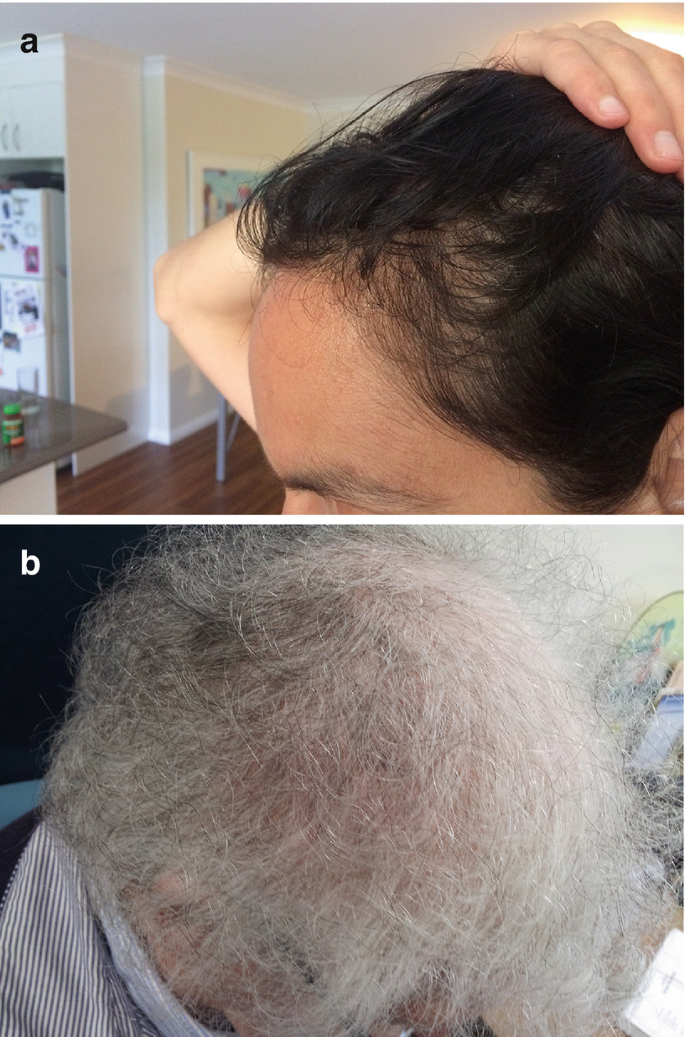 Management of Alopecia Due to Cancer Therapies | SpringerLink Management of Alopecia Due to Cancer Therapies | SpringerLink