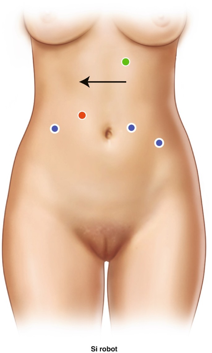 About Oophorectomy Abroad - Intclinics