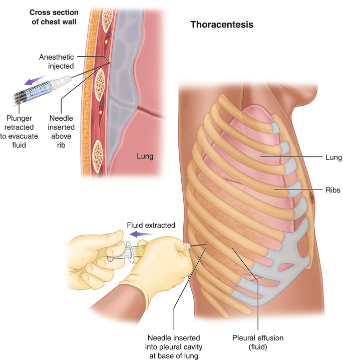 Thoracentesis | SpringerLink